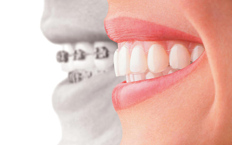 ortodonzia invisalign e apprecchio per bambini o adulti